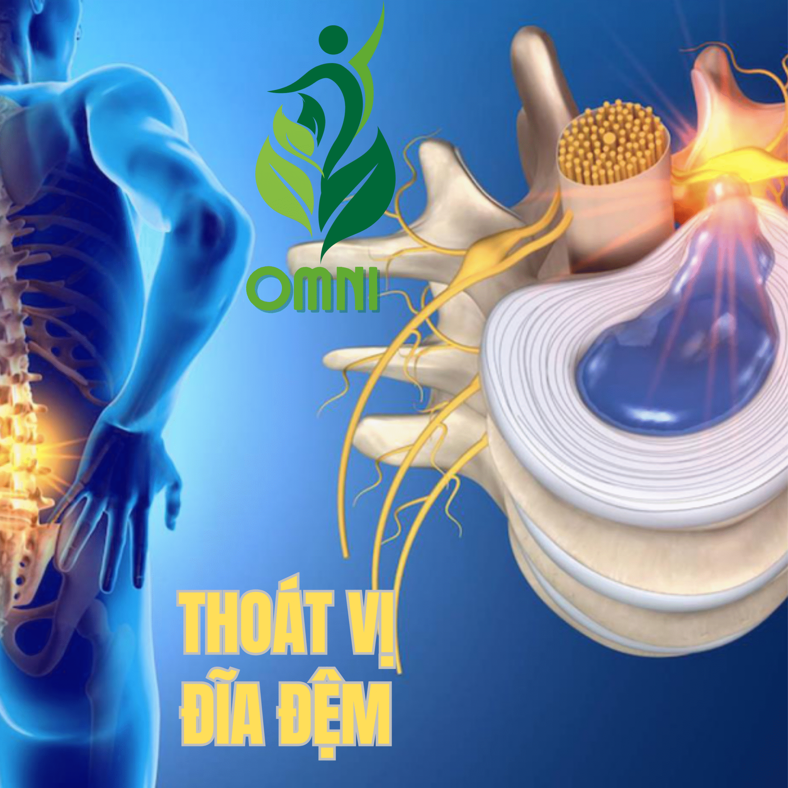 Trị liệu thoát vị đĩa đệm