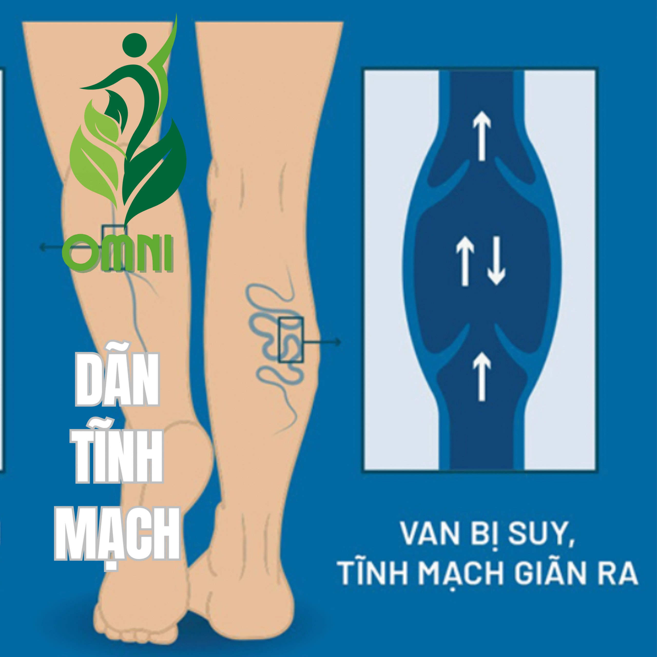 Trị liệu suy giãn tĩnh mạch chi dưới