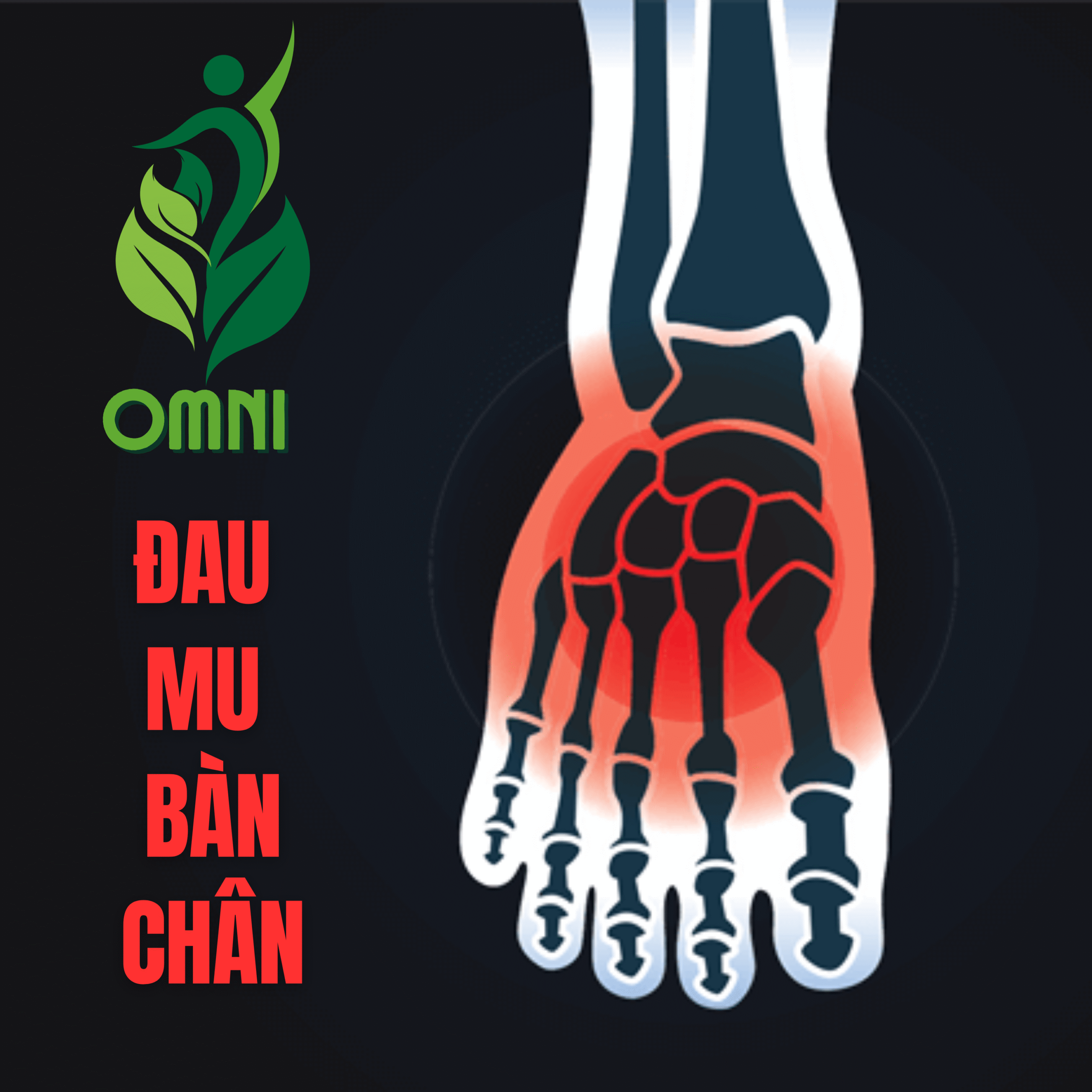 Trị liệu đau mu bàn chân